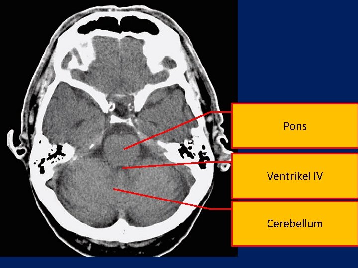 Pons Ventrikel IV Cerebellum 