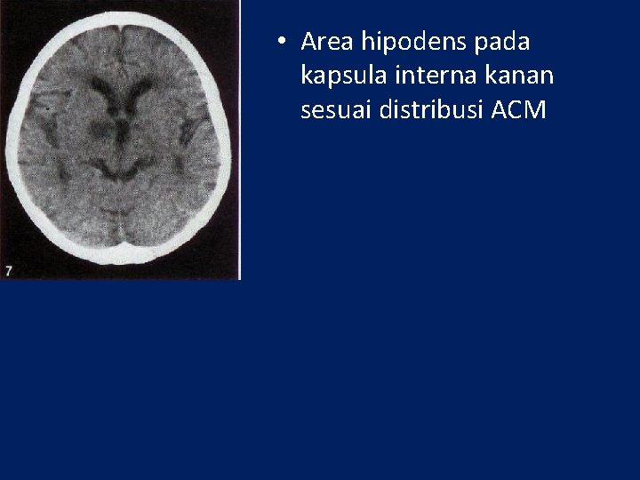  • Area hipodens pada kapsula interna kanan sesuai distribusi ACM 