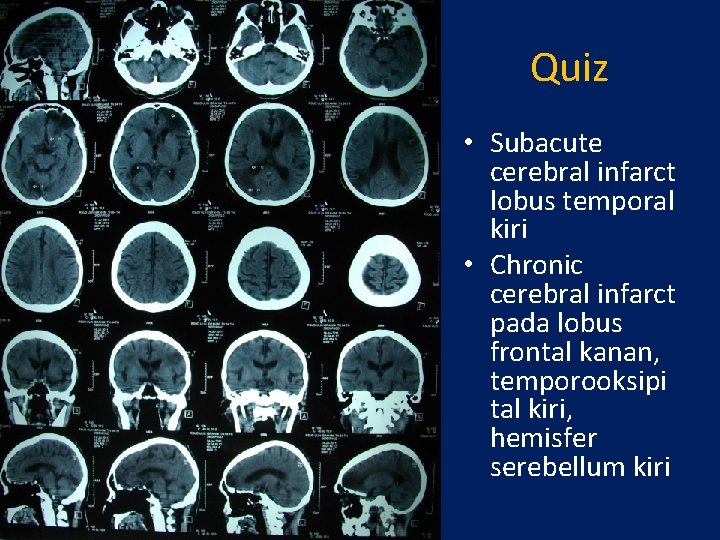 Quiz • Subacute cerebral infarct lobus temporal kiri • Chronic cerebral infarct pada lobus