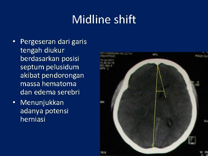 Midline shift • Pergeseran dari garis tengah diukur berdasarkan posisi septum pelusidum akibat pendorongan