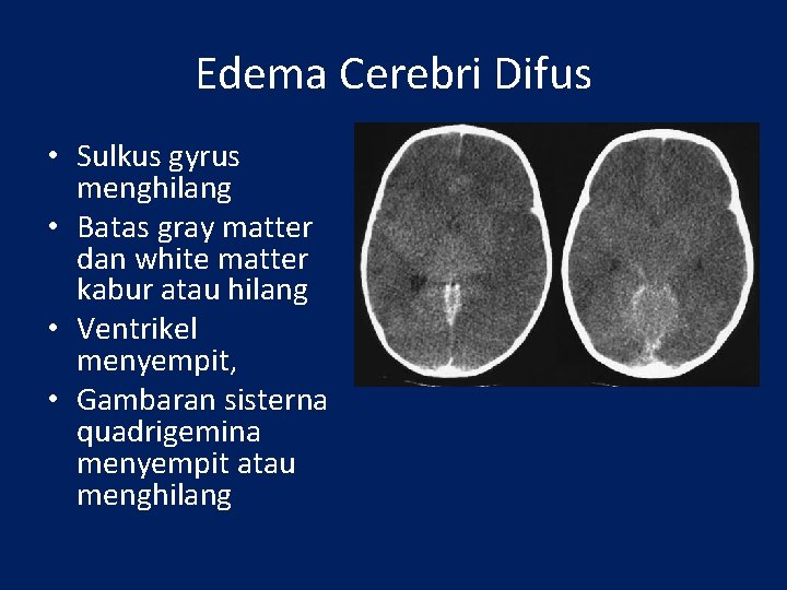 Edema Cerebri Difus • Sulkus gyrus menghilang • Batas gray matter dan white matter