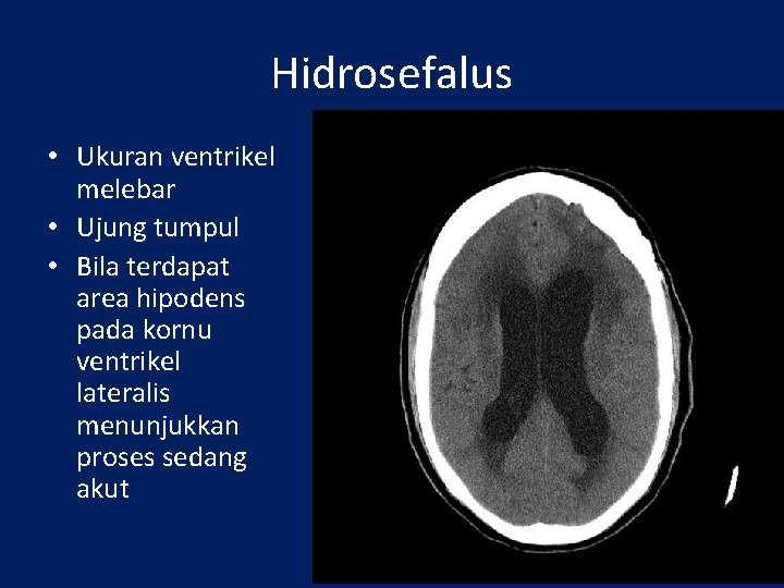 Hidrosefalus • Ukuran ventrikel melebar • Ujung tumpul • Bila terdapat area hipodens pada