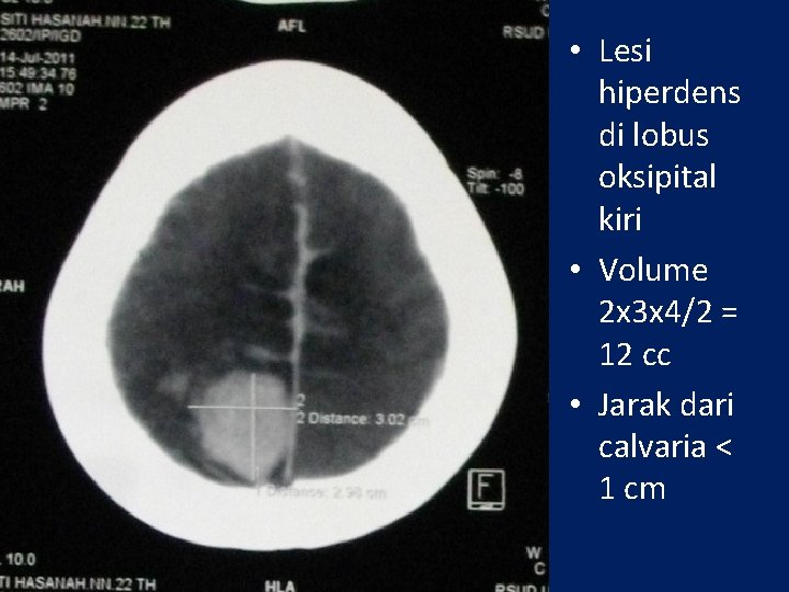 Pada Foto ini • Lesi hiperdens di lobus oksipital kiri • Volume 2 x