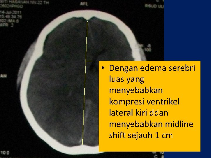  • Dengan edema serebri luas yang menyebabkan kompresi ventrikel lateral kiri ddan menyebabkan