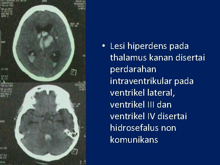  • Lesi hiperdens pada thalamus kanan disertai perdarahan intraventrikular pada ventrikel lateral, ventrikel