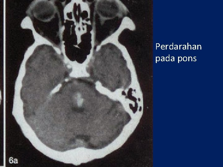  • Perdarahan pada pons 