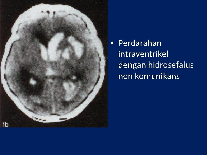  • Perdarahan intraventrikel dengan hidrosefalus non komunikans 