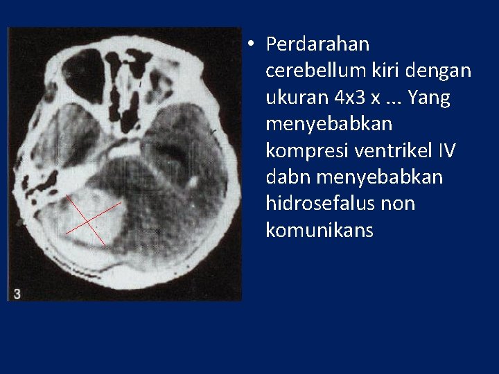  • Perdarahan cerebellum kiri dengan ukuran 4 x 3 x. . . Yang