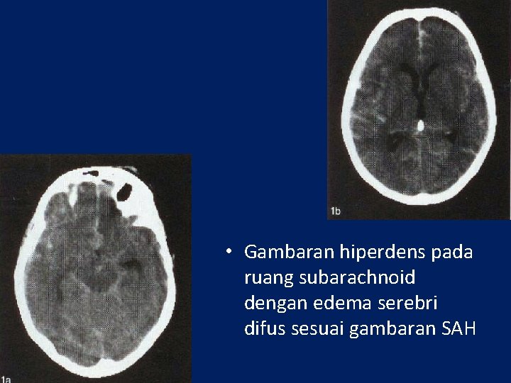  • Gambaran hiperdens pada ruang subarachnoid dengan edema serebri difus sesuai gambaran SAH