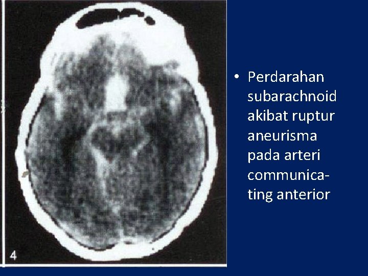  • Perdarahan subarachnoid akibat ruptur aneurisma pada arteri communicating anterior 