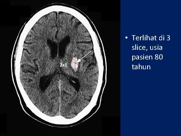 2 x 1 • Terlihat di 3 slice, usia pasien 80 tahun 