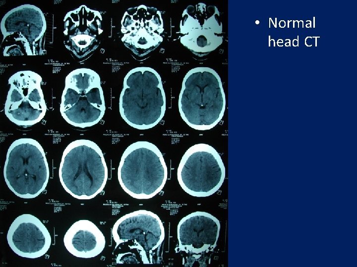  • Normal head CT 