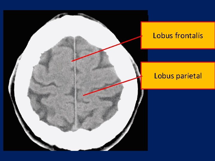 CT Scan Normal Lobus frontalis Lobus parietal 