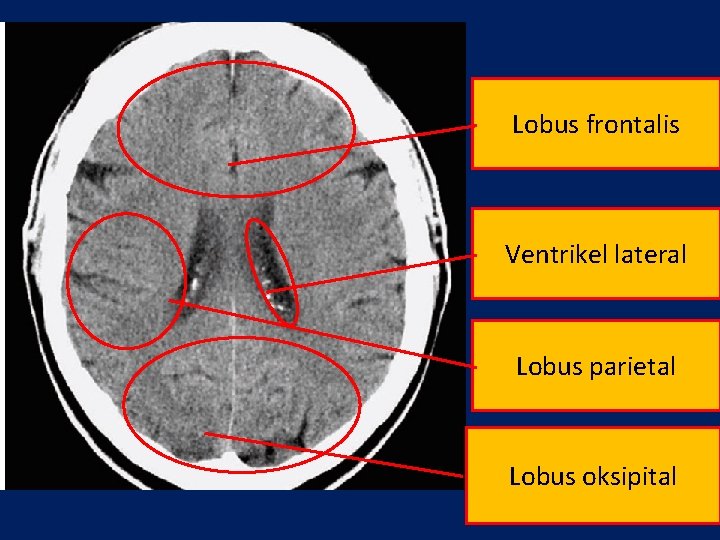 Lobus frontalis Ventrikel lateral Lobus parietal Lobus oksipital 