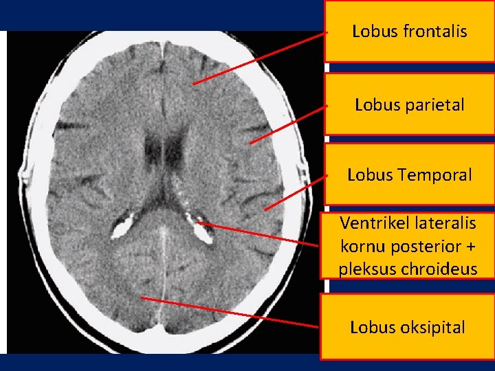 Lobus frontalis Lobus parietal Lobus Temporal Ventrikel lateralis kornu posterior + pleksus chroideus Lobus