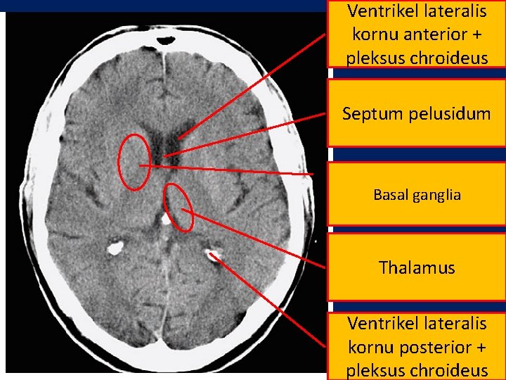 Ventrikel lateralis kornu anterior + pleksus chroideus Septum pelusidum Basal ganglia Thalamus Ventrikel lateralis