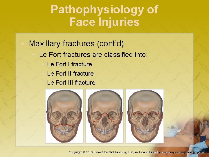 Pathophysiology of Face Injuries • Maxillary fractures (cont’d) − Le Fort fractures are classified