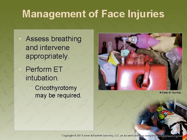 Management of Face Injuries • Assess breathing and intervene appropriately. • Perform ET intubation.