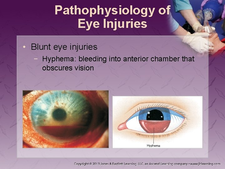 Pathophysiology of Eye Injuries • Blunt eye injuries − Hyphema: bleeding into anterior chamber