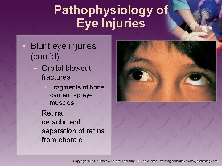 Pathophysiology of Eye Injuries • Blunt eye injuries (cont’d) − Orbital blowout fractures •