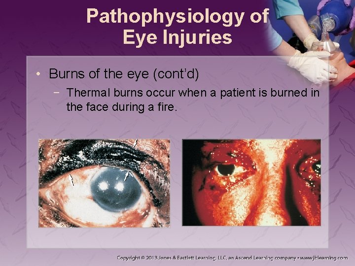 Pathophysiology of Eye Injuries • Burns of the eye (cont’d) − Thermal burns occur
