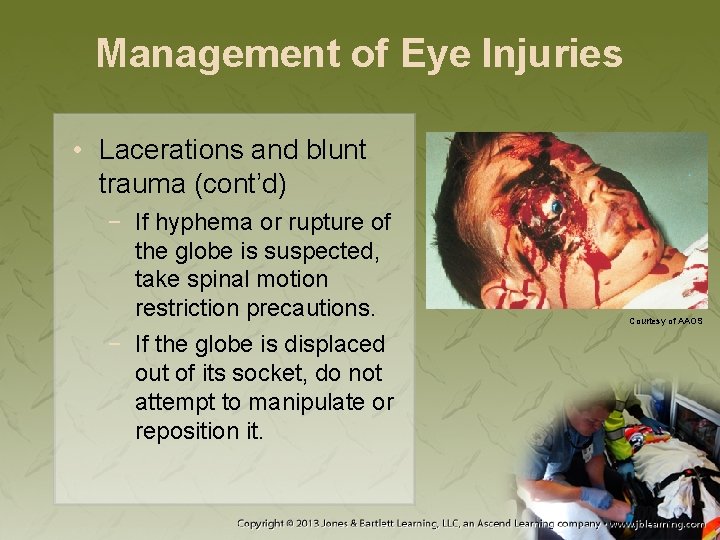 Management of Eye Injuries • Lacerations and blunt trauma (cont’d) − If hyphema or