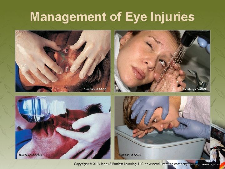 Management of Eye Injuries Courtesy of AAOS 