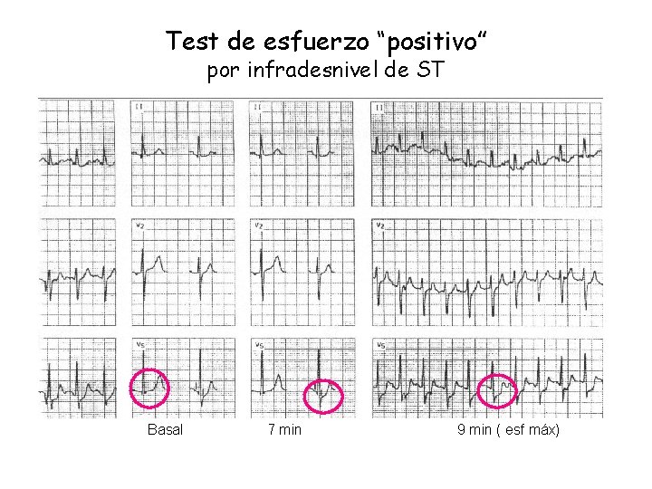 Test de esfuerzo “positivo” por infradesnivel de ST Basal 7 min 9 min ( Test de esfuerzo “positivo” por infradesnivel de ST Basal 7 min 9 min (