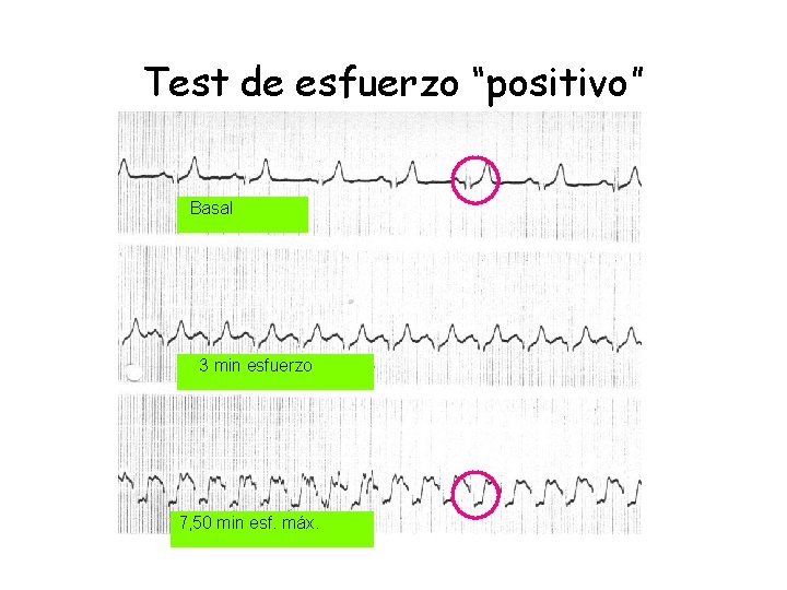 Test de esfuerzo “positivo” Basal 3 min esfuerzo 7, 50 min esf. máx. Test de esfuerzo “positivo” Basal 3 min esfuerzo 7, 50 min esf. máx.