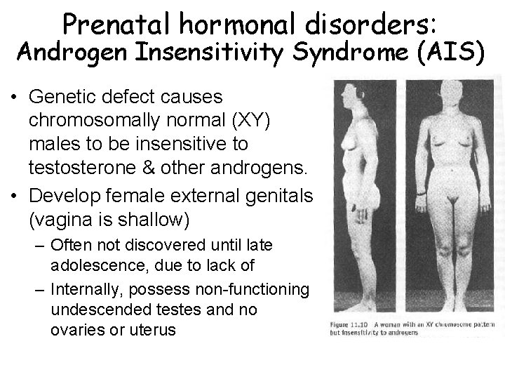 Prenatal hormonal disorders: Androgen Insensitivity Syndrome (AIS) • Genetic defect causes chromosomally normal (XY)