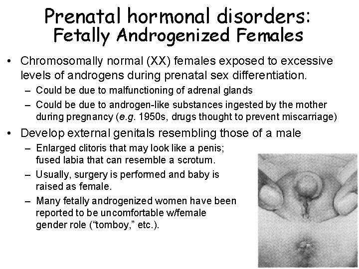 Prenatal hormonal disorders: Fetally Androgenized Females • Chromosomally normal (XX) females exposed to excessive