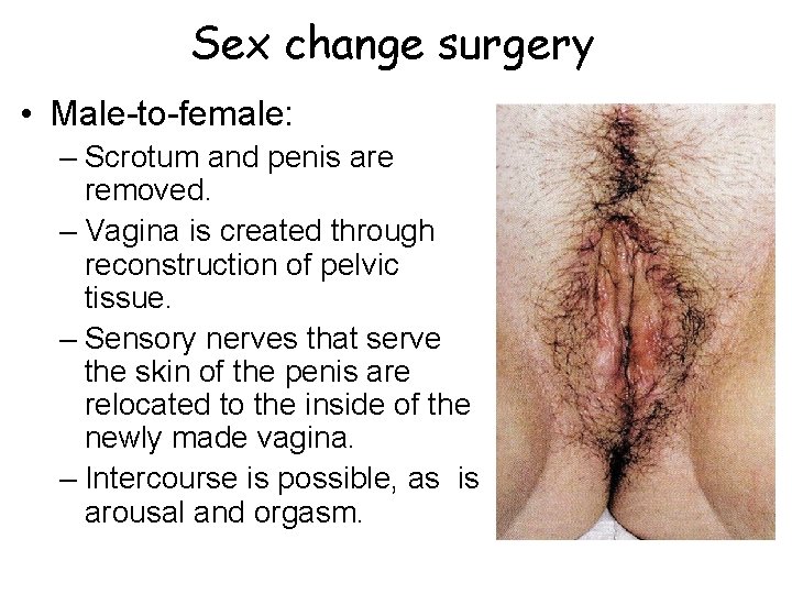 Sex change surgery • Male-to-female: – Scrotum and penis are removed. – Vagina is