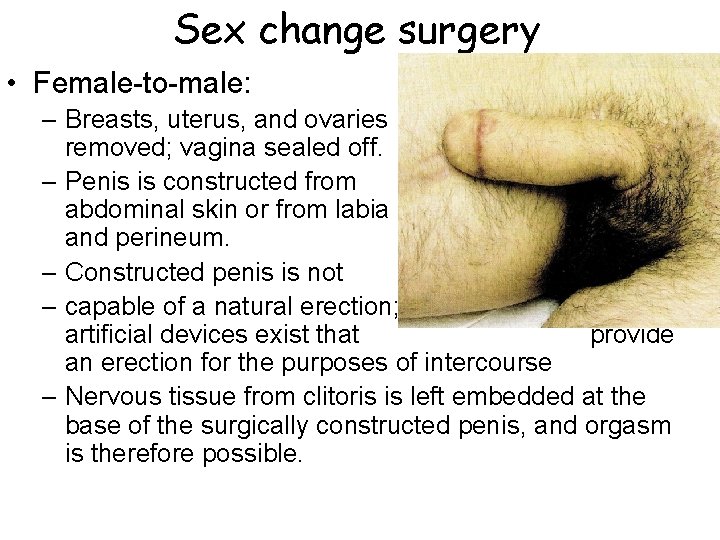 Sex change surgery • Female-to-male: – Breasts, uterus, and ovaries removed; vagina sealed off.