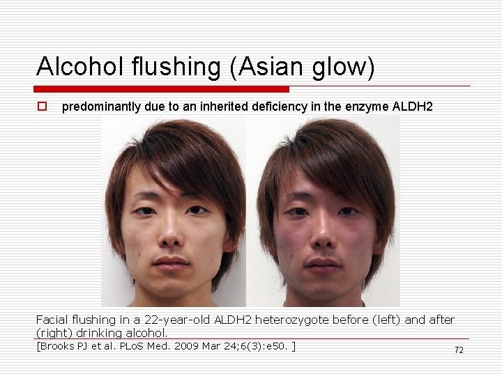 Alcohol flushing (Asian glow) o predominantly due to an inherited deficiency in the enzyme