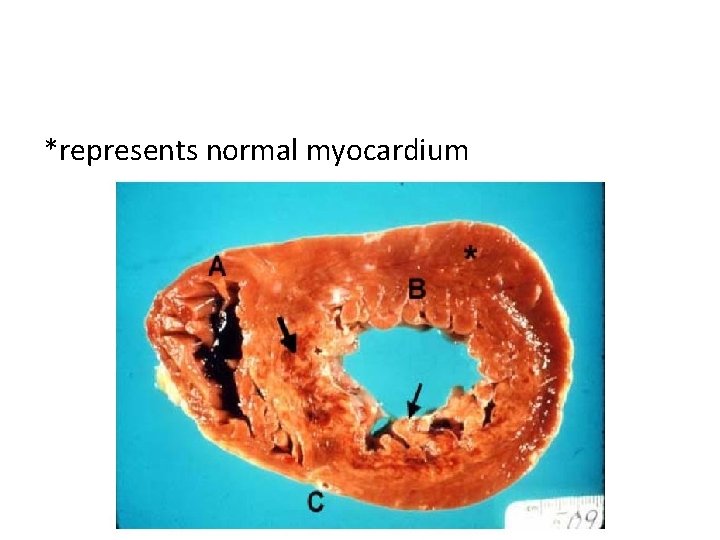 *represents normal myocardium 