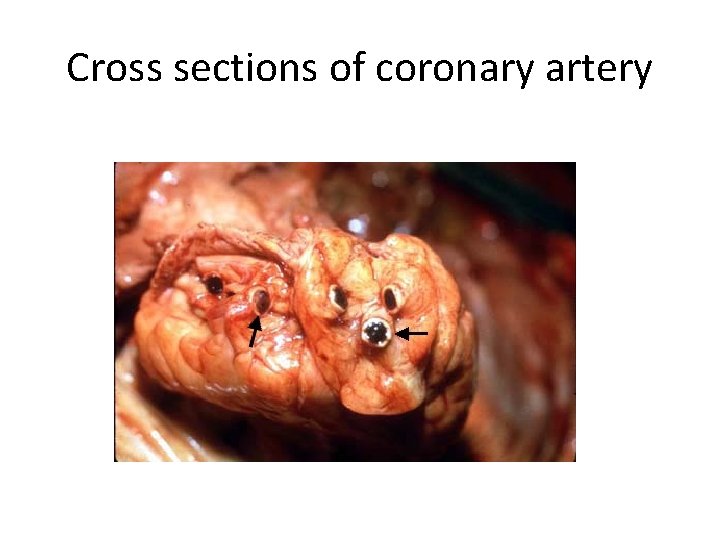 Cross sections of coronary artery 