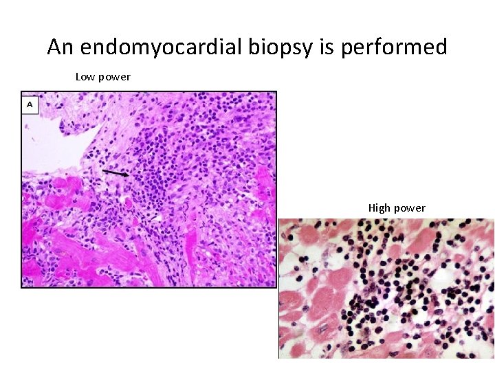 An endomyocardial biopsy is performed Low power . High power 
