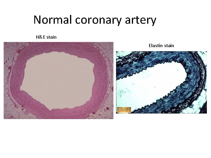 Normal coronary artery H&E stain Elastin stain 
