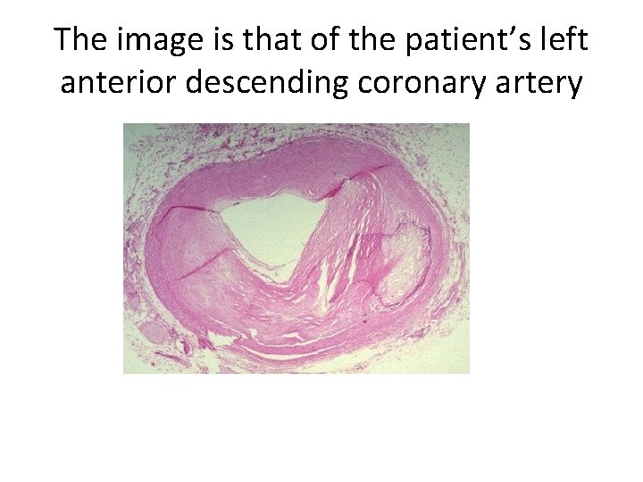 The image is that of the patient’s left anterior descending coronary artery 