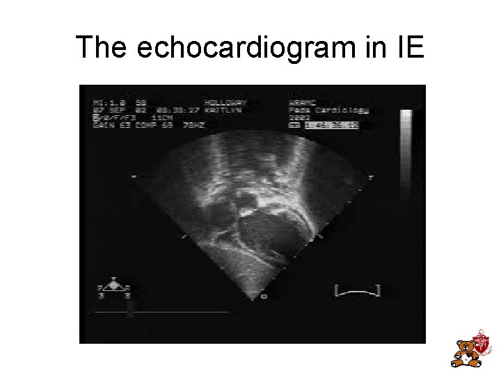 The echocardiogram in IE The echocardiogram in IE