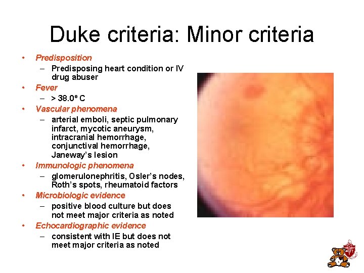 Duke criteria: Minor criteria • • • Predisposition – Predisposing heart condition or IV Duke criteria: Minor criteria • • • Predisposition – Predisposing heart condition or IV