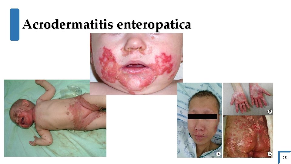 Acrodermatitis enteropatica 25 