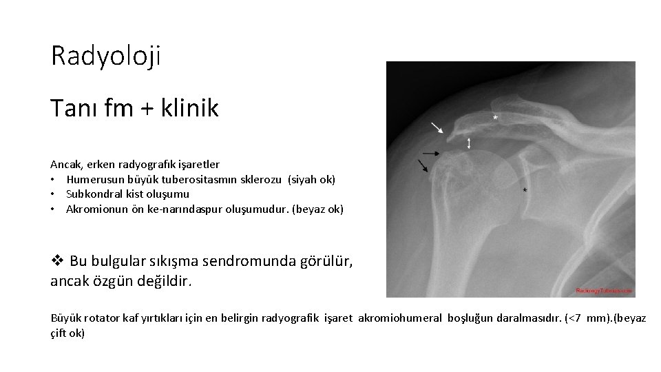 Radyoloji Tanı fm + klinik Ancak, erken radyografık işaretler • Humerusun büyük tuberositasmın sklerozu