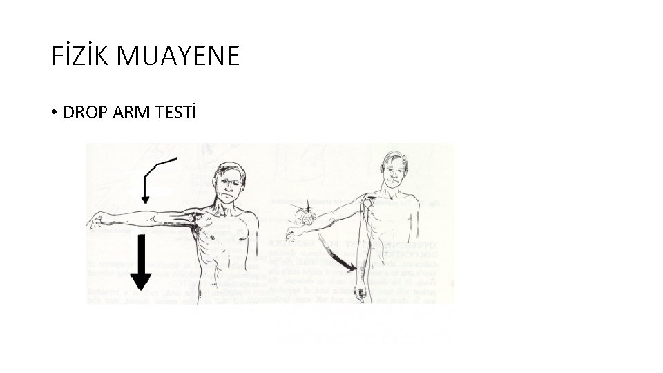 FİZİK MUAYENE • DROP ARM TESTİ 