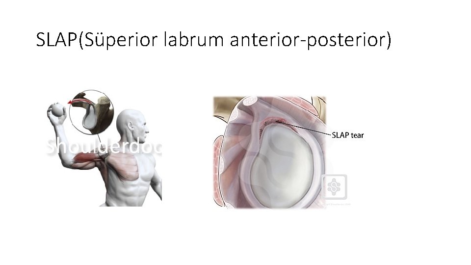 SLAP(Süperior labrum anterior posterior) 