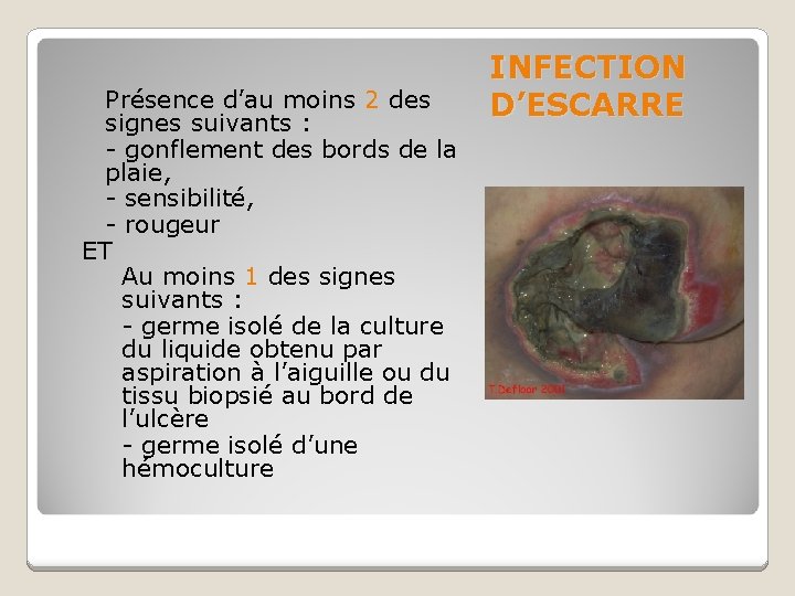 Présence d’au moins 2 des signes suivants : - gonflement des bords de la