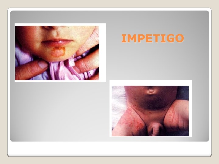 IMPETIGO 