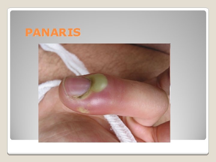 PANARIS 
