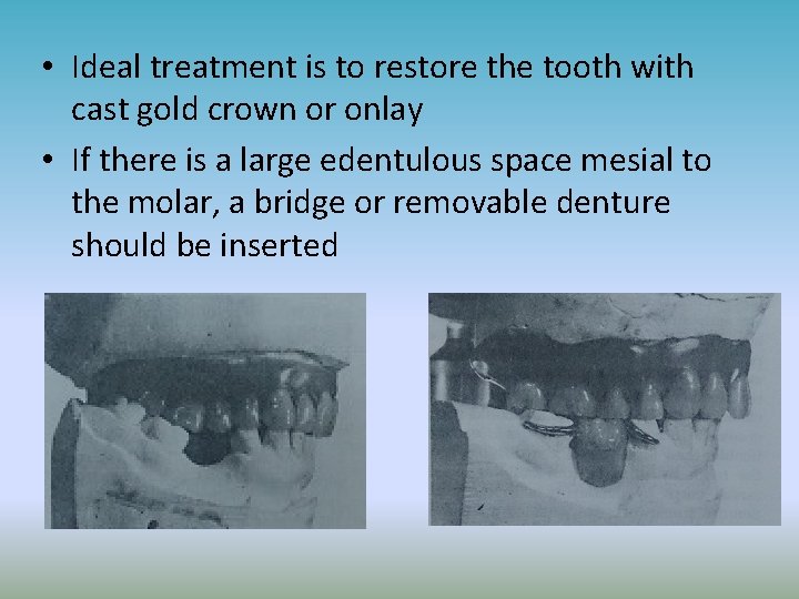  • Ideal treatment is to restore the tooth with cast gold crown or