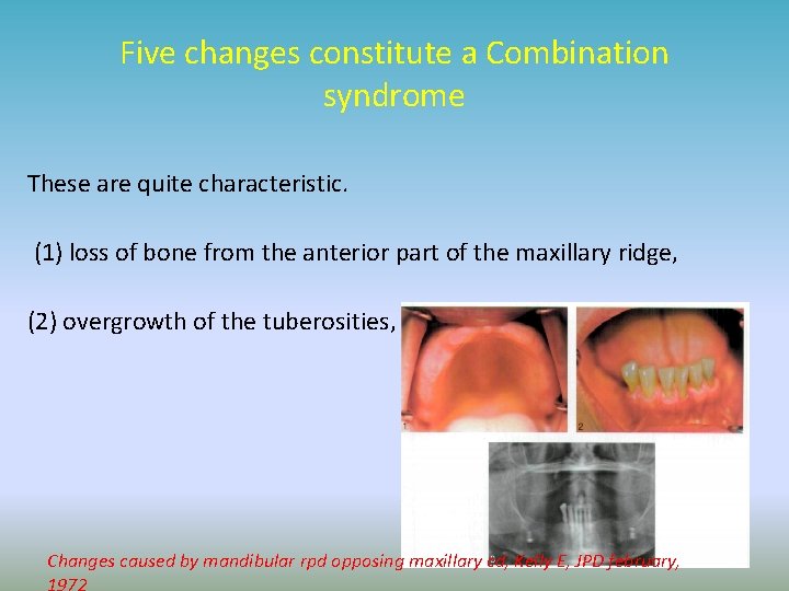 Five changes constitute a Combination syndrome These are quite characteristic. (1) loss of bone